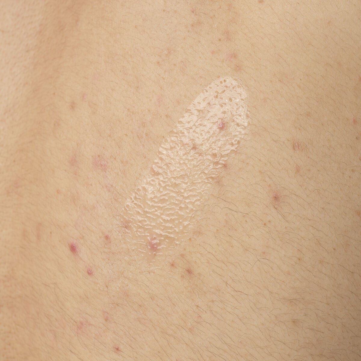 salicylic-acid-0-5-body-serum-h2 ORD-salicylic-acid-05-body-240ml-application.jpg