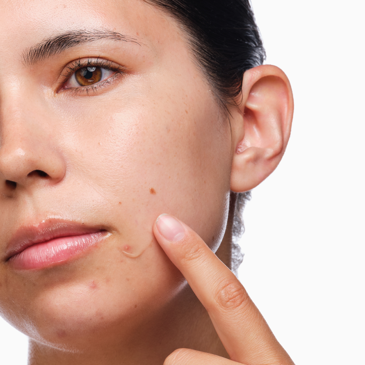 the-acne-set-m3 rdn-the-acne-set-application.png