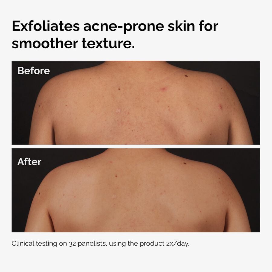 the-body-care-collection-j4 ord-salicylic-acid-body-serum-before-after-graphic-NA.jpg